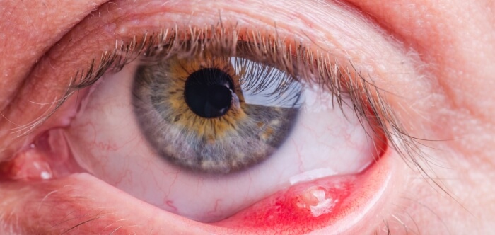 Definition of Stye- A Quick Overview