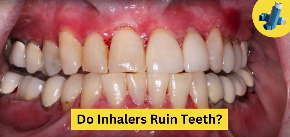 Do Inhalers Ruin Teeth