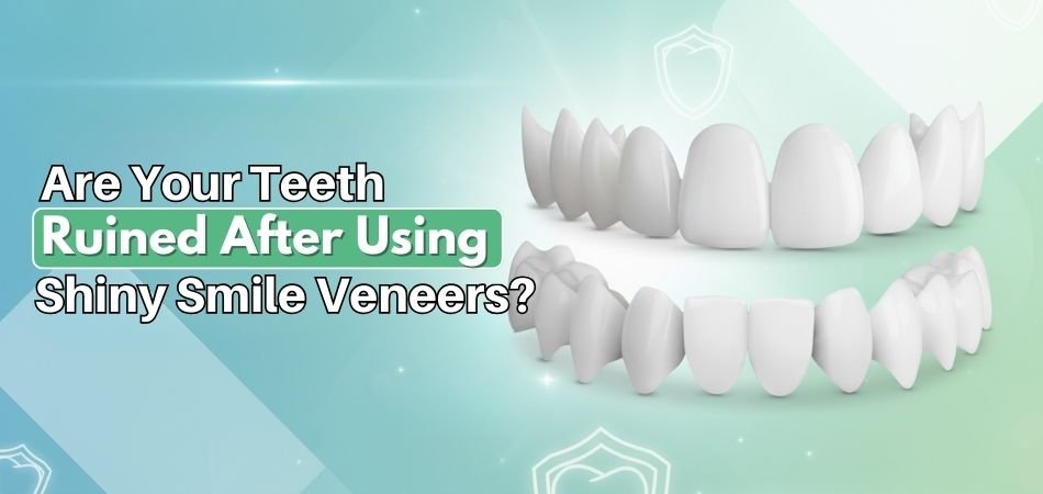 Are Your Teeth Ruined After Using Shiny Smile Veneers