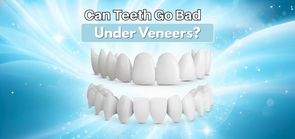 Can Teeth Go Bad Under Veneers