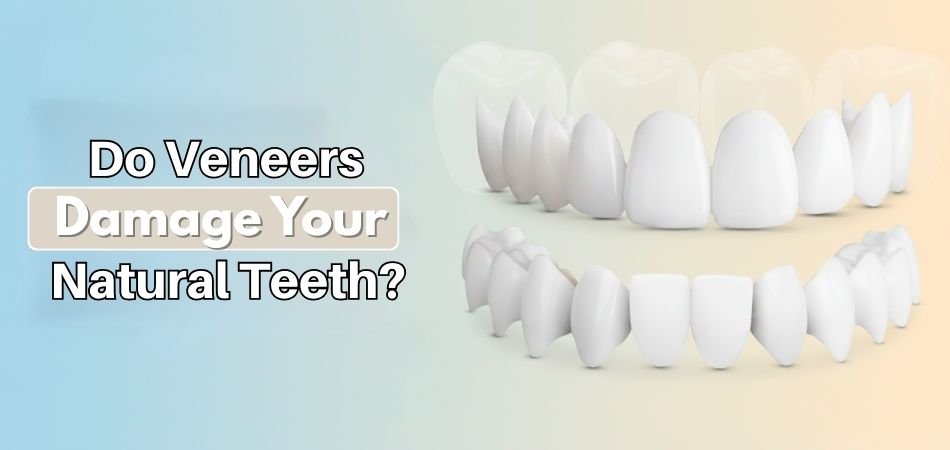 Do Veneers Damage Your Natural Teeth